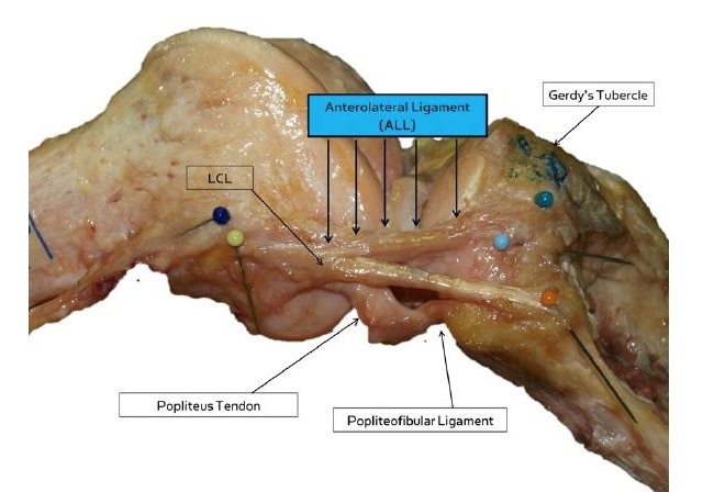 ligamento anterolateral Se descubre un nuevo ligamento en la rodilla humana