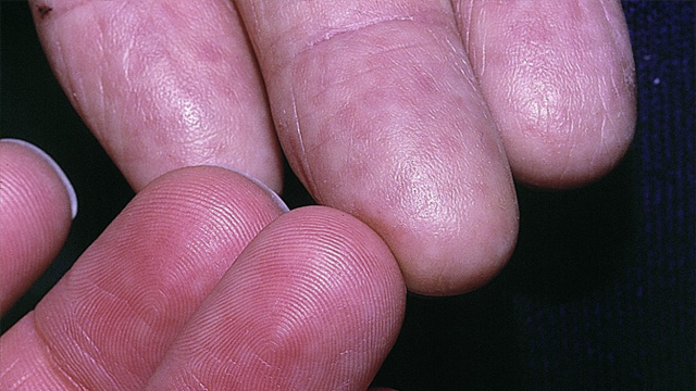 Adermatoglifia Adermatoglifia: el trastorno genético de personas que nacen sin huellas dactilares