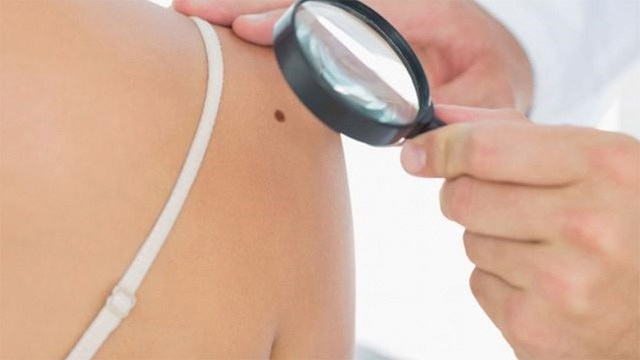 Los lunares en el brazo derecho señalan las probabilidades de padecer cáncer de piel 14 brazo derecho Los lunares en el brazo derecho señalan las probabilidades de padecer cáncer de piel
