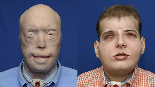 transplante before after Un hombre se recupera del transplante de cara más complejo de la historia