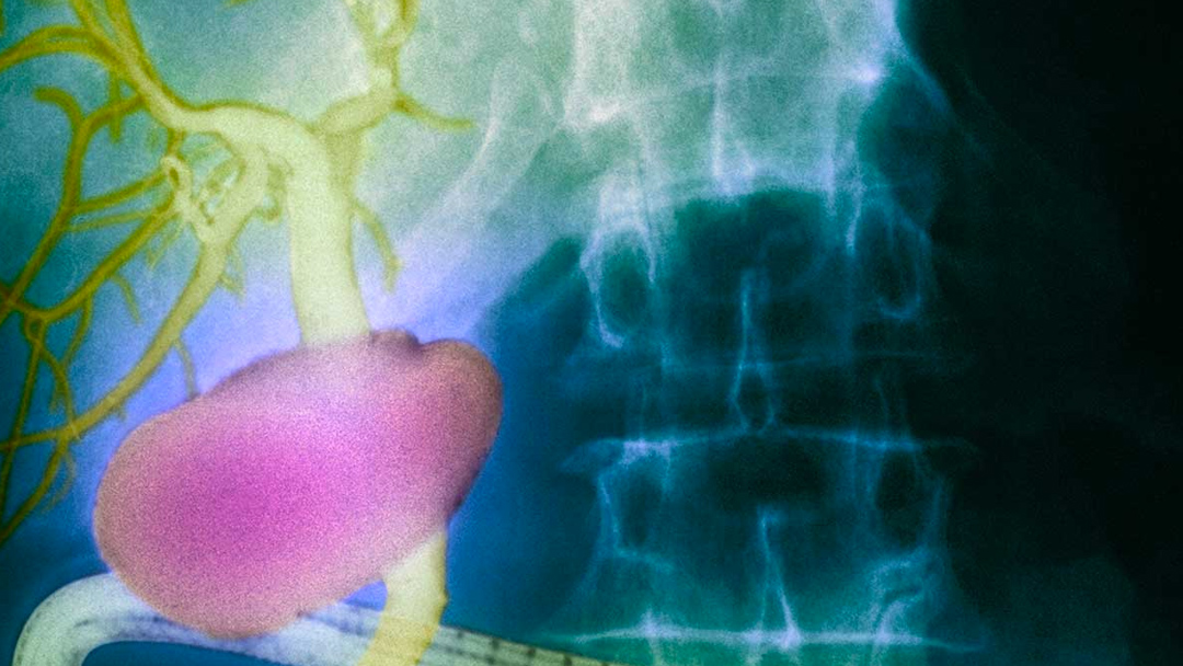 organo canales cancer “Intersticio”: el órgano recién descubierto que podría ayudar a diagnosticar el cáncer