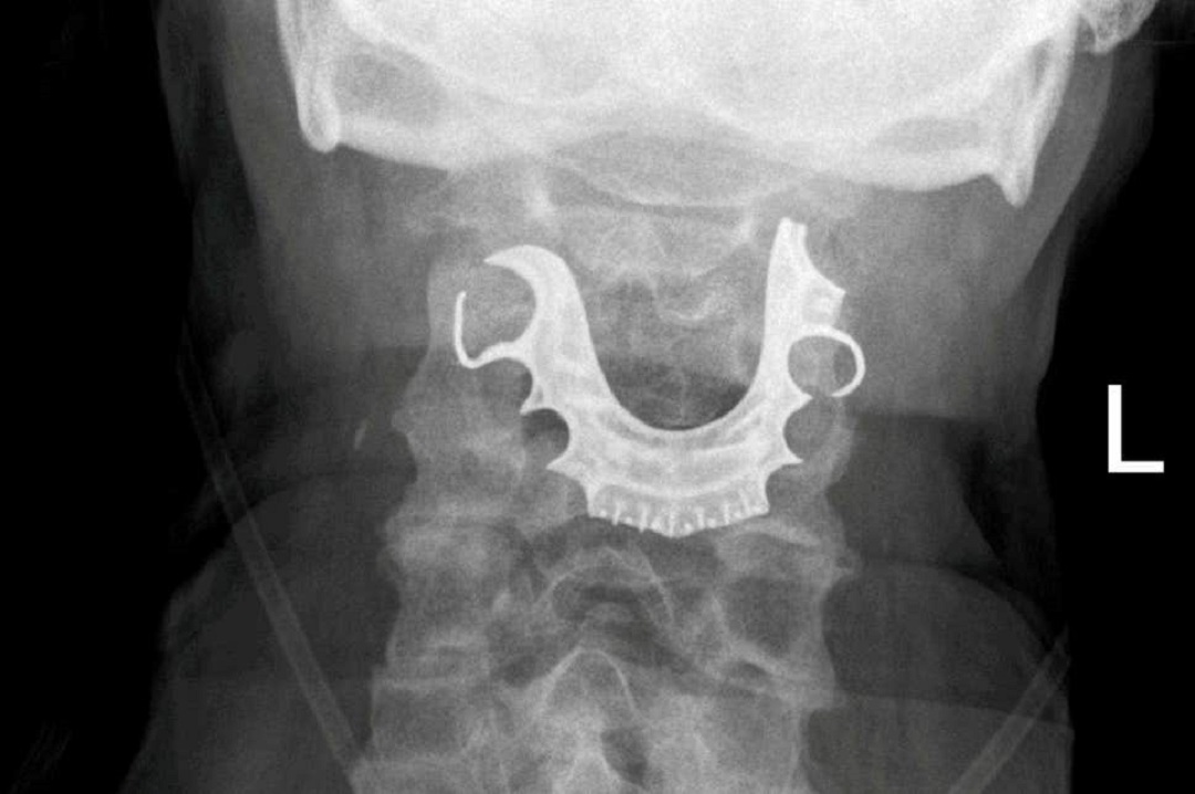 Hombre se traga dentadura postiza en operación