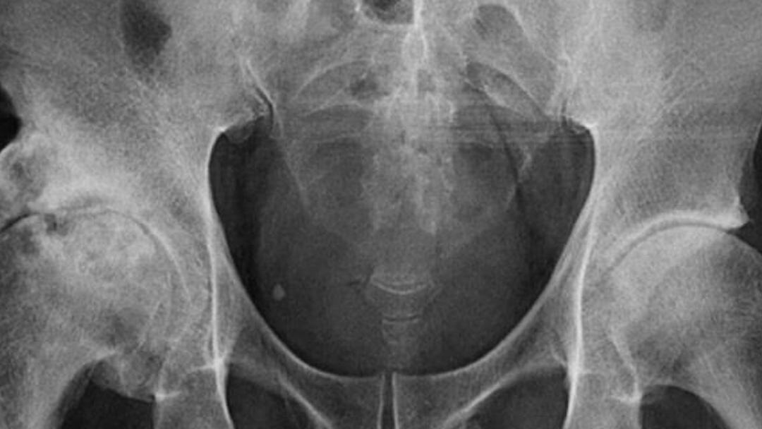 radiografia pene calcificado El pene de este hombre se está convirtiendo en hueso