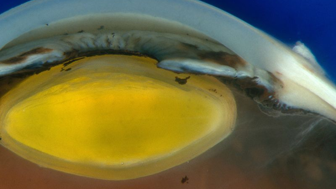 cornea celulas madre Mujer recibe primer trasplante de córnea hecha de células madre reprogramadas