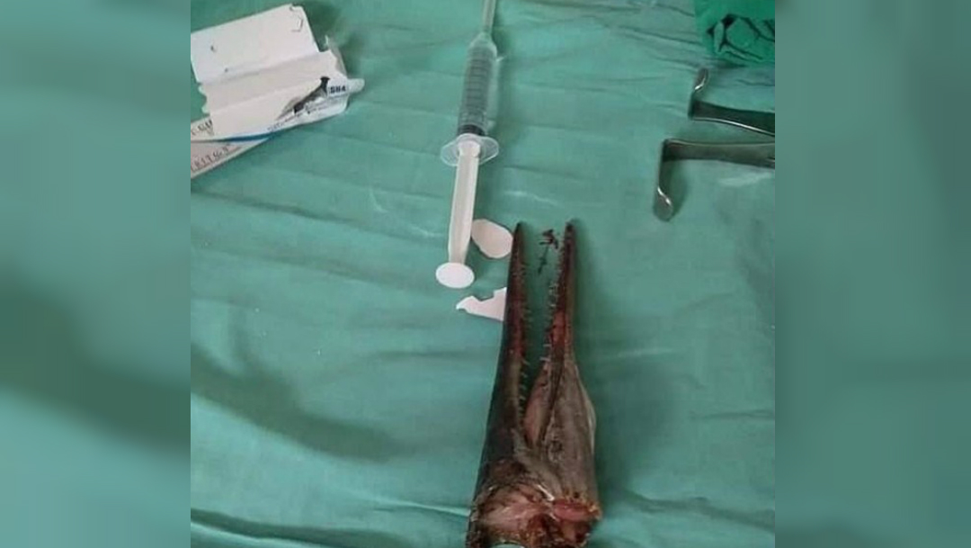 Pez Espada Volador Este pez espada atravesó el cuello de un joven en Indonesia y llegó hasta su cráneo