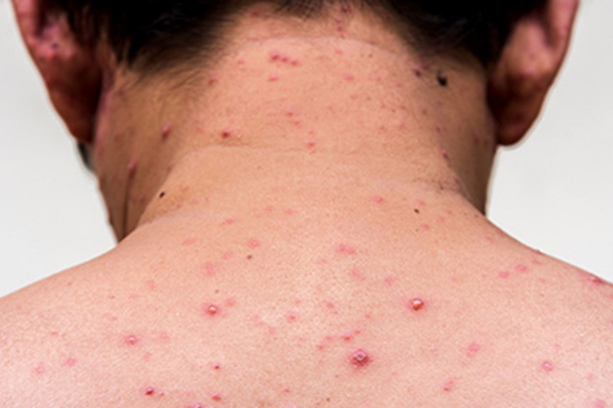 Sarampion Casos Ciudad México