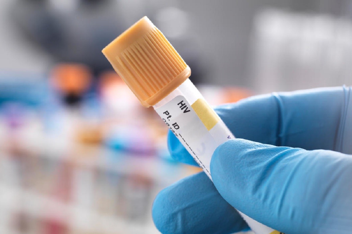 VIH Segundo Paciente Curado