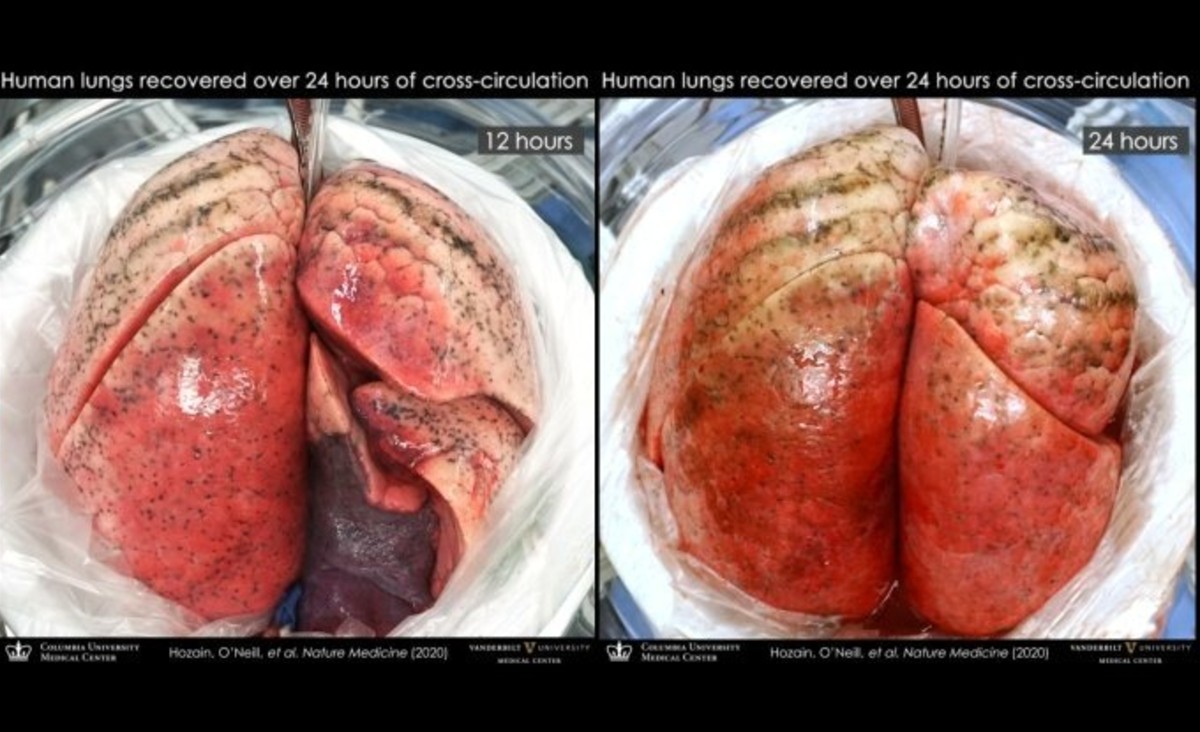 Curan pulmones humanos al implantarlos en cerdos con vida 21 Curan Pulmones Cerdos