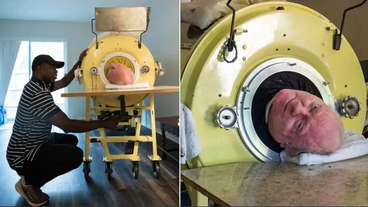 Hombre con pulmón de acero muere